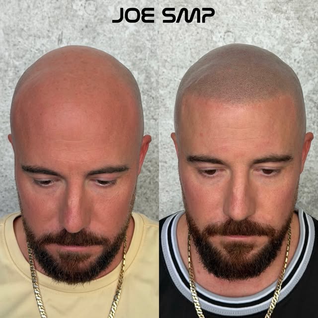 ANOTHER AMAZING TRANSFORMATION 👀🔥

A fresh hairline can completely change the look. With SMP, we r