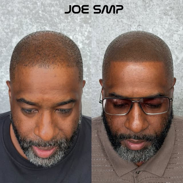 DENSITY FILL-IN 👀🔥

Thinning hair doesn’t always mean you need a new hairline. SMP can fill in bet