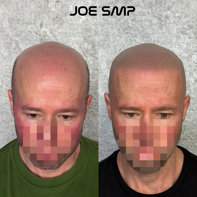 NEW TRANSFORMATION 👀🔥

From hair loss to a fresh, natural-looking hairline. SMP helped completely 