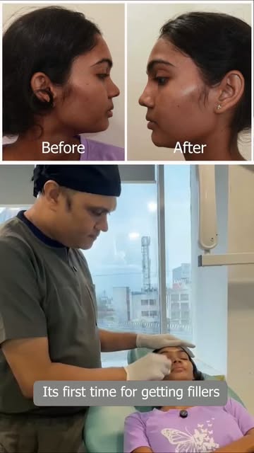 Your profile deserves just as much attention as your front-facing features.

Nose filler can be used