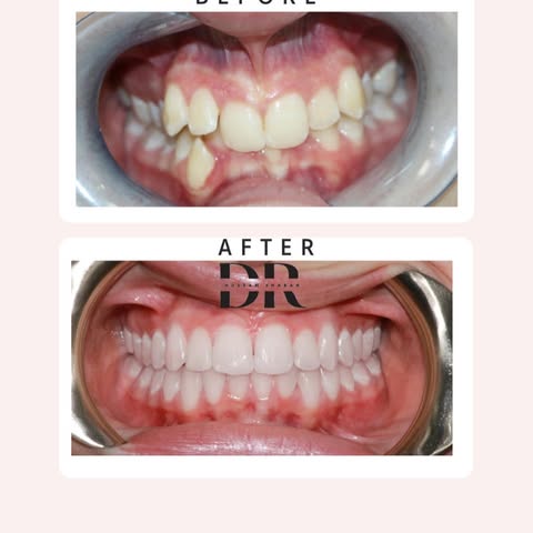 حالة تراكب اسنان شديد تم علاج بدون قلع الاسنان باستخدام جهازDamon  braces #تقويم_اسنان #تقويم_شفاف #