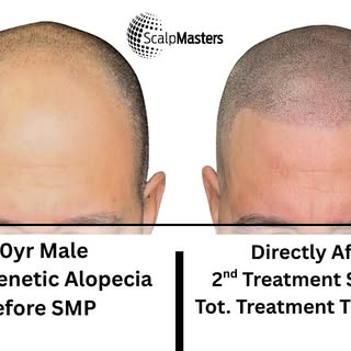 Send me your bald friends:
I’m on a roll this month. 🦾

#reno #scalpmicropigmentation #renoscalpmic