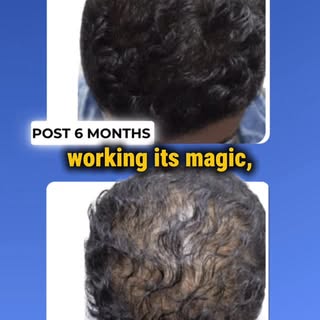Diffuse pattern thinnng? ScalpMasters can fix that in 1 hour, using your body’s own regenerative cel