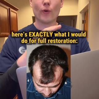 The real savior for the young men rocking that “Vegeta”hairline is: A regenerative transplant. 
We a