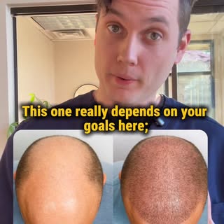 To my long-time “horseshoe” baldies: Here are the 2 best options for permanent restoration.