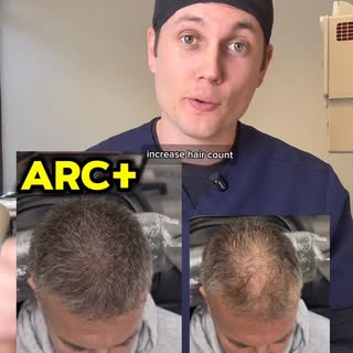 Diffuse pattern thinning? Here are the best permanent solutions. 

#Baldness #diffuse #hairtransplan
