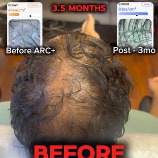 Excellent ARC+ Therapy results for this patient, in both hair count and hair diameter.
#ARC+Therapy 