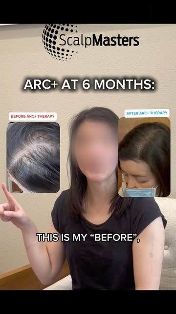 Jenny saw a huge increase in density from just one treatment of ARC+. If you are thinning like she i