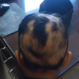 Cured Case of Alopecia Areata , 

#drasifali #clinicamedicare #bhopal #beforeafter #transformation