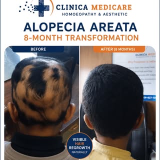 Alopecia Areata: An 8-Month Transformation
A 9-year-old boy from Indore came to Clinica Medicare wit