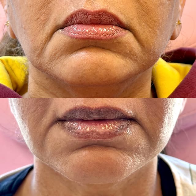 ✨ Lift naturally. Glow confidently. ✨

Give your skin the ultimate collagen boost with Ultherapy® — 