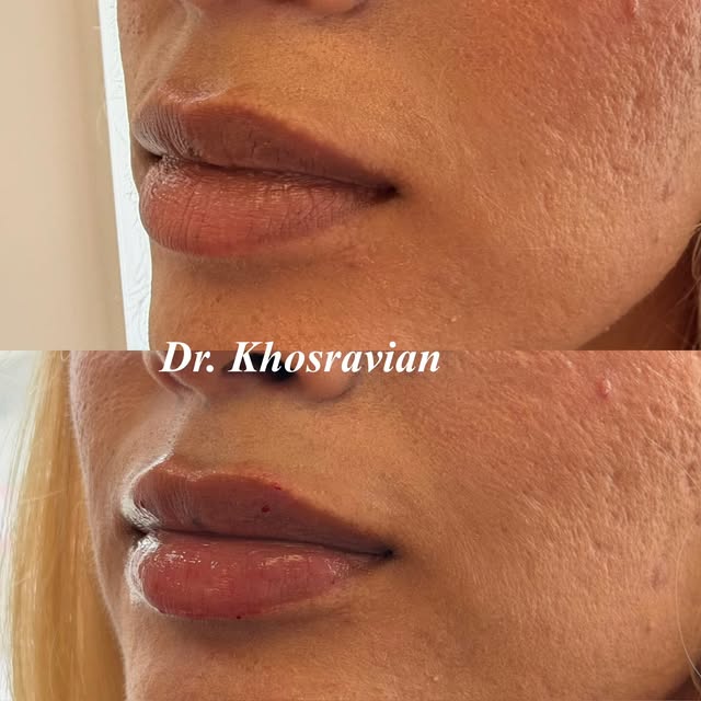 Small tweak, big confidence boost ✨ Our mini lip filler treatments add subtle volume and definition,