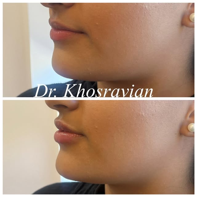 A little balance makes a beautiful difference ✨

Chin and lip filler to enhance the profile while ke