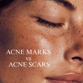 Acne marks and acne scars are not the same thing - and treating them the same won’t get you results.