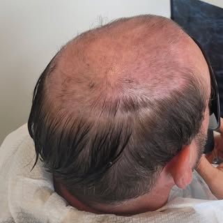 SWIPE to see this incredible transformation!! 

We fitted a skin system to create a flawlessly natur