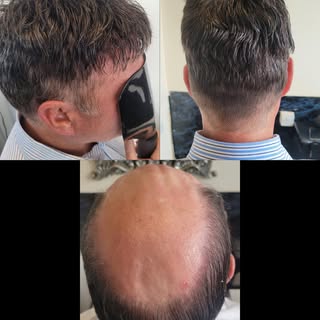 Some crazy transformations we have done this week!! #hairsystem #eliteninehairclinic #nonsurgicalhai