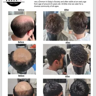 Some of our newest transformations. Androgenic alopecia also referred to as male pattern hair loss i