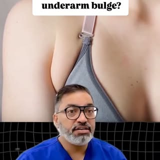 Everything you need to know before planning Axillary Fat Pad Removal Surgery - explained clearly in 