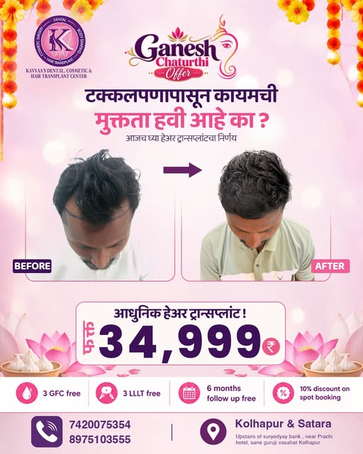 टक्कलपणामुळे confidence कमी होतोय? आता थांबायचं नाही… बदलाची सुरुवात आजच करा! ✨

केस गळतीमुळे Hairli