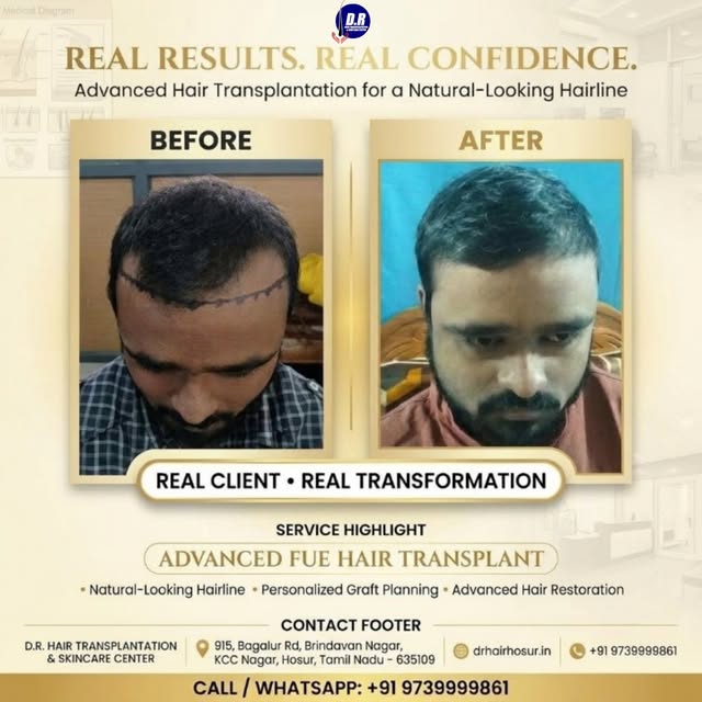 ✨ REAL RESULTS. REAL CONFIDENCE. ✨

🌱 ADVANCED FUE HAIR TRANSPLANTATION FOR A NATURAL-LOOKING HAIRL