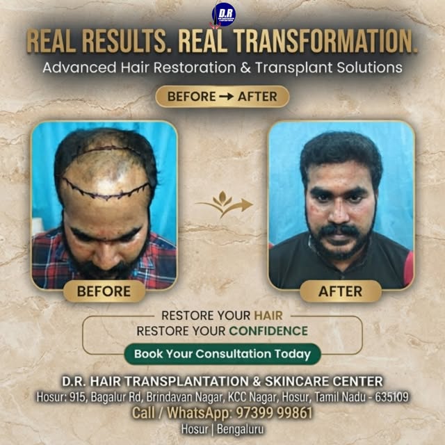 ✨ REAL RESULTS. REAL TRANSFORMATION. ✨

🌱 ADVANCED HAIR RESTORATION & TRANSPLANT SOLUTIONS

Hair re