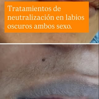 #maquillaje #micropigmentacion #labios #garantia. La neutralización de labios,  está indicado para a