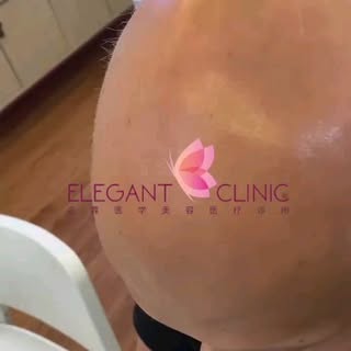 全秃或普秃的病程，一般较斑秃更长些，而且恢复很慢。有的患者可能长年不愈，甚至成为永久性秃发。

有的患者刚开始只是少数脱发片块，但随着病情的不断进展，脱发区周围的头发很容易脱落
经过数周或数月可使大部