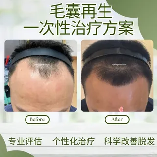 头发，其实是身体的一面镜子。🪞
生活作息、压力、睡眠，都会影响毛囊健康。

今天想分享一位国外中年男性的真实案例。
创业初期，因为长期压力大、睡眠不足，掉发越来越严重。
但为了拼事业，他一直没有理会