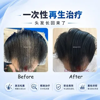 你是不是也觉得，自己只是天生头发比较细软？

年轻时，为了让头发看起来更蓬松，很多人都会选择烫发😊。
今天分享一位中年顾客的真实案例。

一直以来，他都认为自己只是头发细软。直到有一天，理发师提醒他