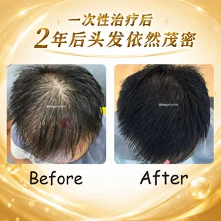 你以为只是掉发，其实可能是雄激素性脱发🫠

当发际线越来越后退、头顶越来越稀疏、发量越来越少，这些都可能是雄激素性脱发的警讯🚨

别等到毛囊逐渐萎缩，才开始重视。

今天想分享一位真实顾客的故事�