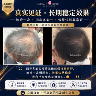 ❇️真实案例分享

🌷4年多后的今天，他的效果依然保持得很好👏🏻

每位顾客对治疗的期待都不同😉

这位顾客平时是一位非常忙碌的生意人，每天都忙着处理自己的事业，工作安排得非常紧凑，因此他当初
