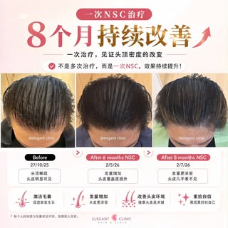 好看的状态，从来都值得被看见🌷

他是生意人，也是驻唱歌手，同时拥有多样的事业。

他非常注重自己的形象

而头发，恰恰是他最在意、也最不愿妥协的一部分。

过去也曾花过不少钱尝试不同的方法，
却始