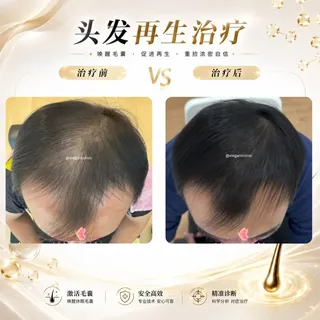 「家里人都有脱发，
所以我脱发一定是遗传的？」

先别急着下结论。

遗传确实可能是脱发的原因之一，
但脱发，从来不只是「遗传」这么简单。

有些人甚至没有经历明显的狂掉头发，
却发现：

发际线越来
