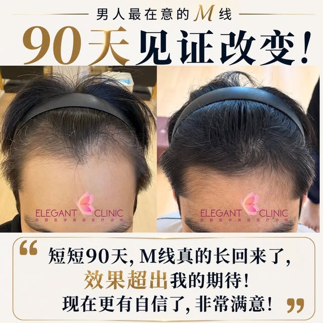 ☀️ 年轻，不代表可以忽略发际线。

他是一个很阳光、很有活力的男生。

其实在还很年轻的时候，他就已经发现自己的 M线好像越来越高了。

一开始，他也没有太在意。

想着可能只是自己想太多，
也可能