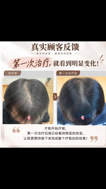 他21岁时，开始担心一件事。

不是考试，也不是工作，
而是照镜子时发现，头发好像变少了。

后来，连理发师也注意到了。

他开始留意发际线和头顶发量，洗头时也会观察掉发情况。

头发没有突然大量脱落