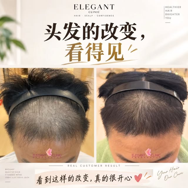 哎呦😂早知道，我三十多岁的时候就来了🙈

这是他完成疗程后，跟我们说的一句话。

其实，他从三十多岁开始，就已经发现头顶慢慢变得稀疏，头皮露白也越来越明显。

但那个时候，他并没有太在意。因为他以