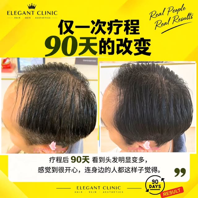“其实我最在意的，就是我的头发。”

Mr P 是一位40多岁的男士，他是老婆孩子一起陪着来咨询的。

第一次见面的时候，他就很明显地告诉我们，自己其实一直都很在意脱发这个问题。

因为头发越来越少，