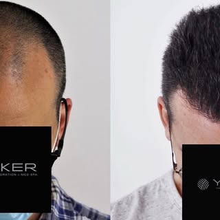 New hair, new you! This is the SAME person, and only a year after his procedure. This patient underw