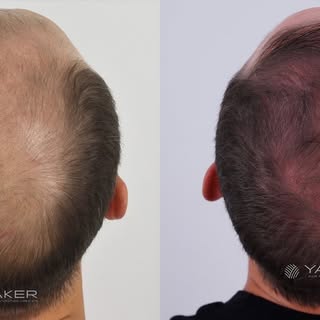 The 6th stage of the Norwood scale is considered an advanced stage of male pattern hair loss. With t