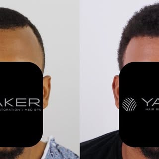 SmartGraft™ FUE is recommended for patients of all hair colors and textures that do not want an inva