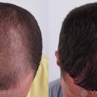 After only 9 months of using Dr. Joseph Yaker’s specially compounded Finasteride + Minoxidil, HÄR La