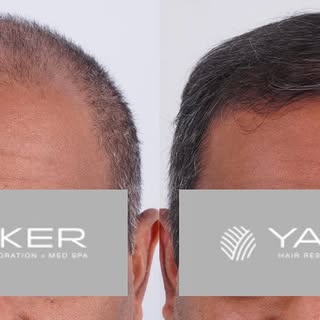 Did we just go back in time? Nope! This patient is enjoying his youth again after only 9 months of a