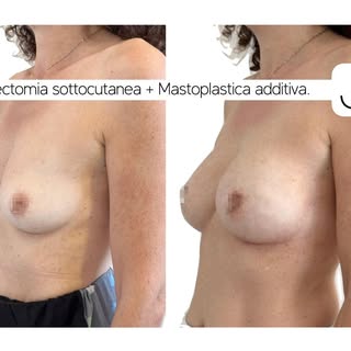 Affiancare una mastoplastica additiva a un intervento di mastectomia preventiva permette di garantir