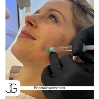 Complessi biorivitalizzanti antinfiammatori iniettati in aree limitrofe all’acne in fase attiva poss