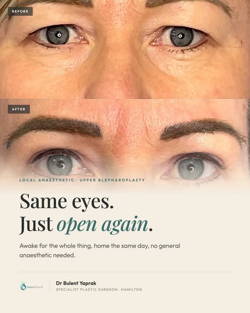 Upper blepharoplasty under local anaesthetic. Awake the whole time, home the same day, no general an