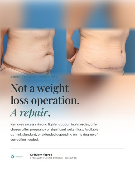 A tummy tuck isn't a weight loss operation. It's for the loose skin and stretched muscles that stay 