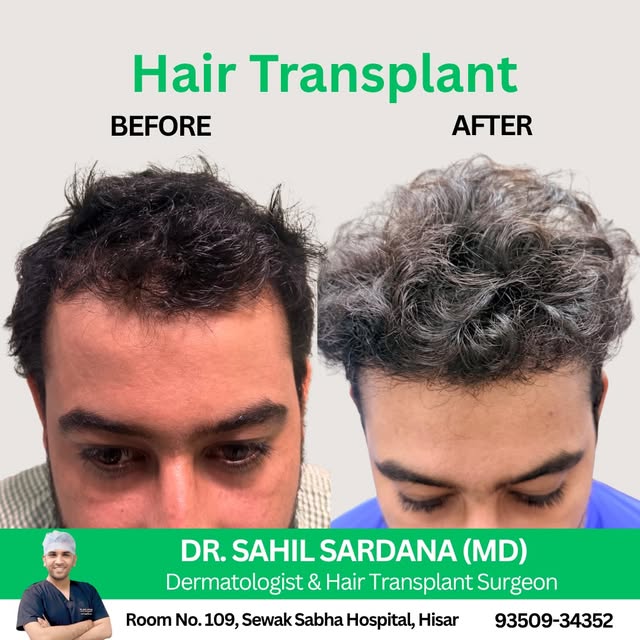 Transform your confidence with advanced hair transplant solutions ✨

Hair loss is not just about app