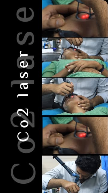 CO₂ Fractional Laser for Skin Renewal ✨

Concerned about acne scars, uneven skin texture, fine lines
