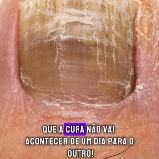 O tratamento da micose das unhas dos pés sempre é um desafio!

É um tratamento longo, pois, as unhas