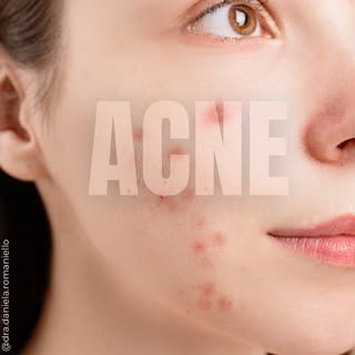 A Acne é uma doença crônica, inflamatória com grande impacto na autoestima, principalmente se for tr